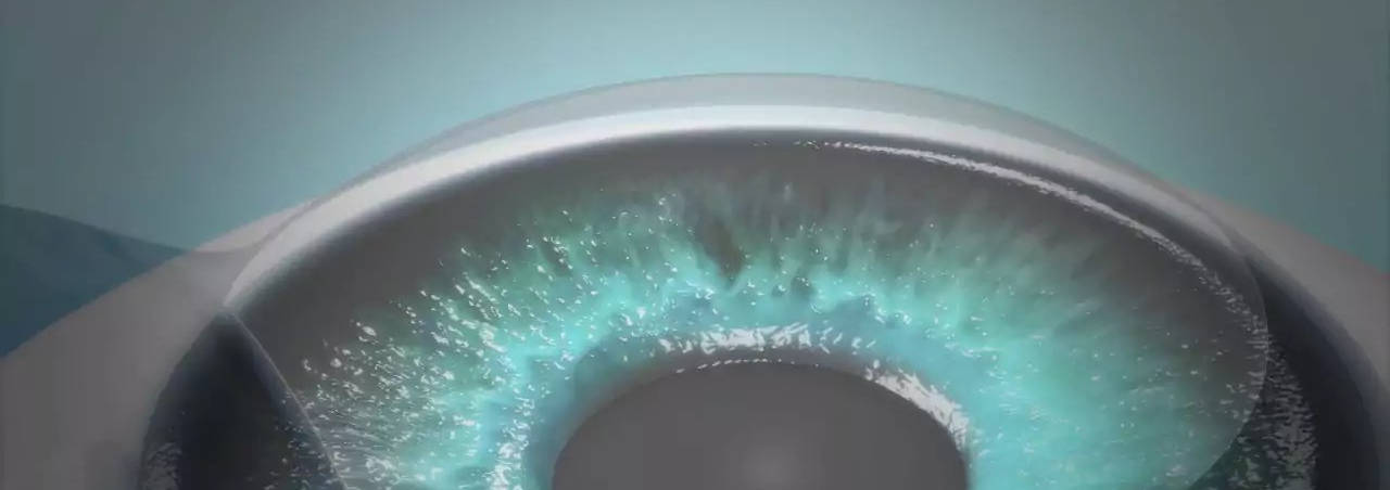 Featured image of Opération Laser des Yeux à Bruxelles - LASIK et PRK | Dr Andriantafika
